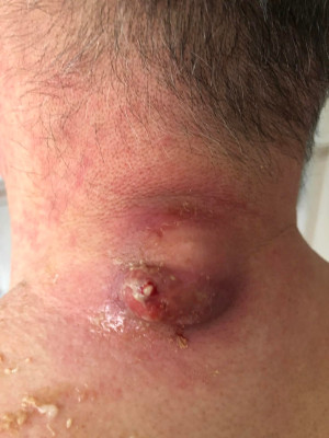 Skull's - Sebacious Cyst  LHM+